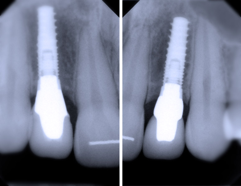 Cirugía oral implantes