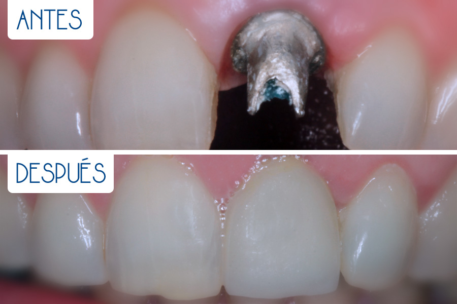 Prótesis dental convencional sobre implante