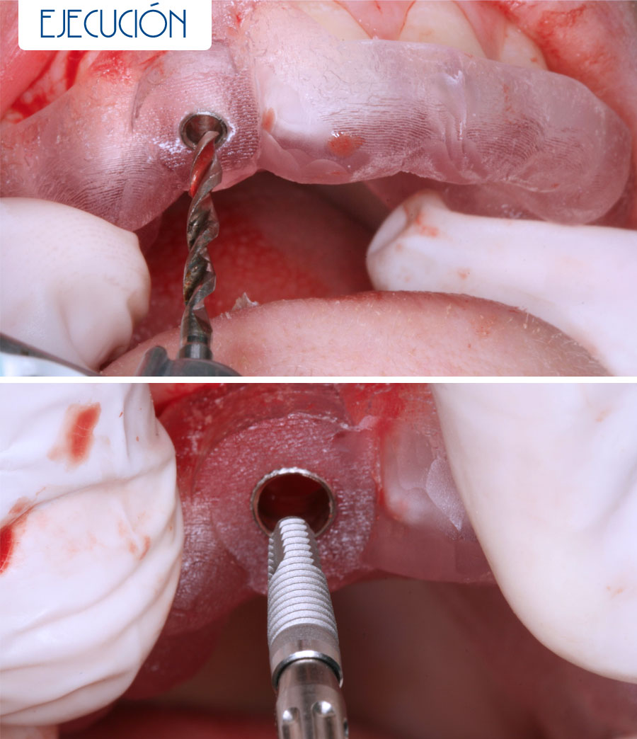 Ejecución - Agenesia lateral más implante más cosmética dental