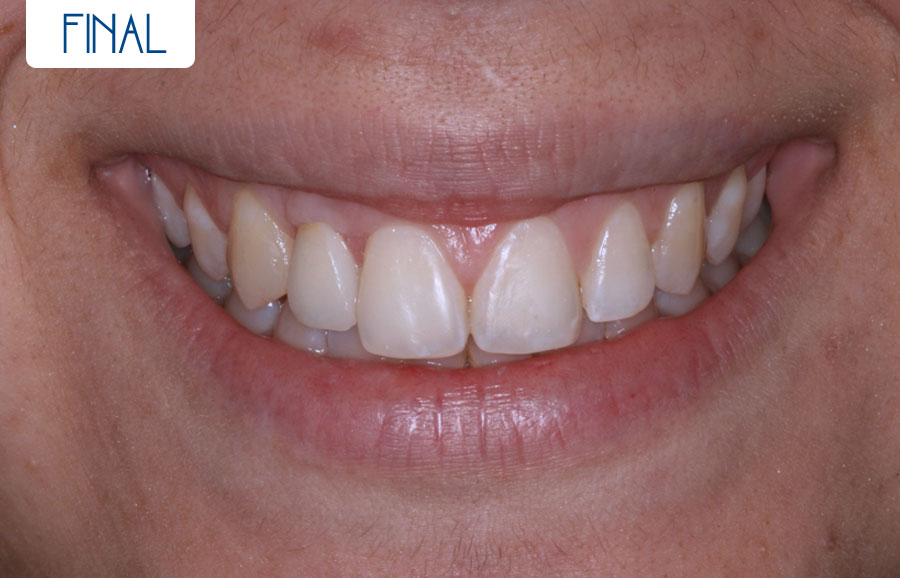 Final - Agenesia lateral más implante más cosmética dental
